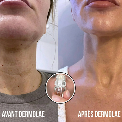 Micro-Infusion Anti-Âge Dermatologique